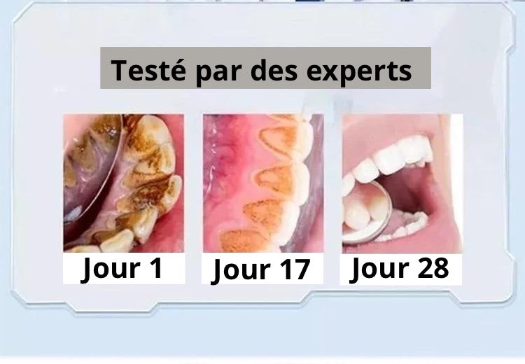 Second Dentifrice blanchissant probiotique Gestion de la santé bucco-dentaire(Élimine des années de taches)
