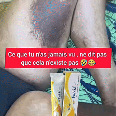 Fevicid Crème – Anti-Mycoses, Tâches Noires et Boutons de Rasage | Résultats rapides et visibles