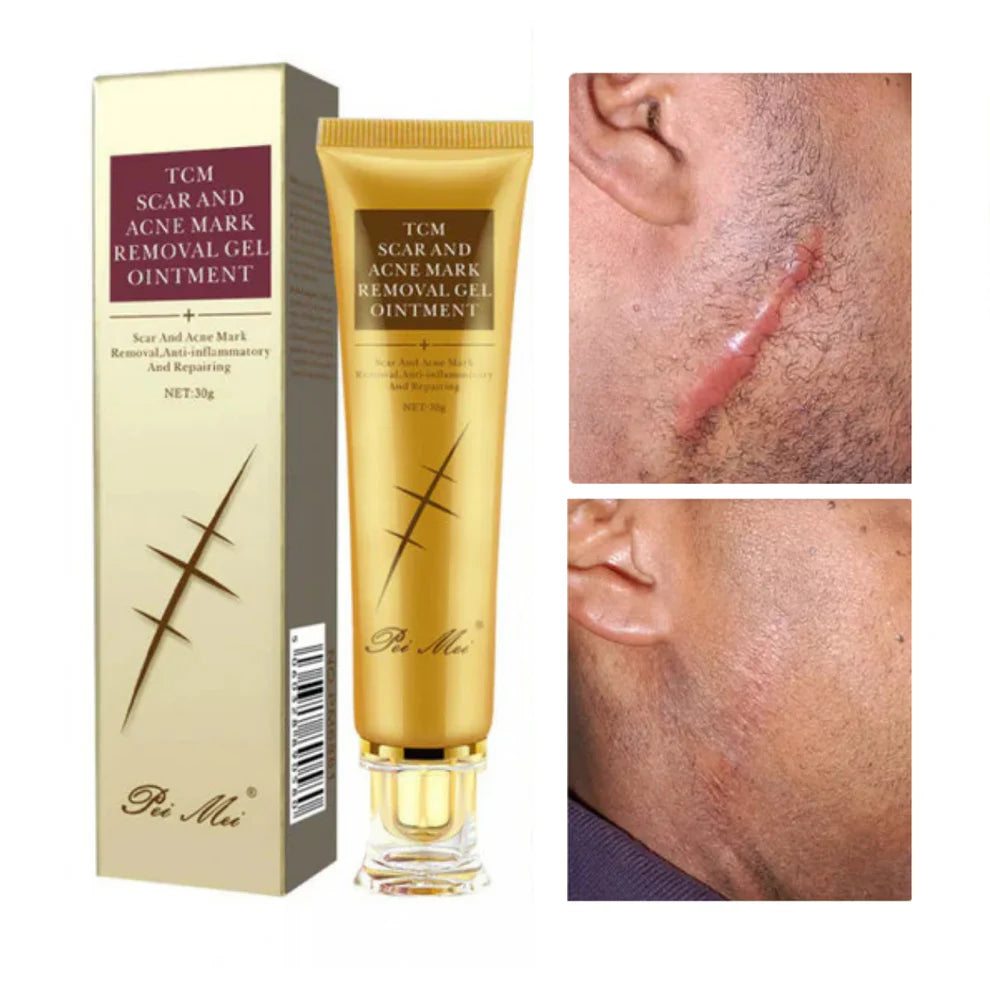 GEL REPARATRICE DE CICATRICE,VERGETURE,TACHE & ACNE TCM