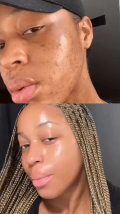 GEL REPARATRICE DE CICATRICE,VERGETURE,TACHE & ACNE TCM