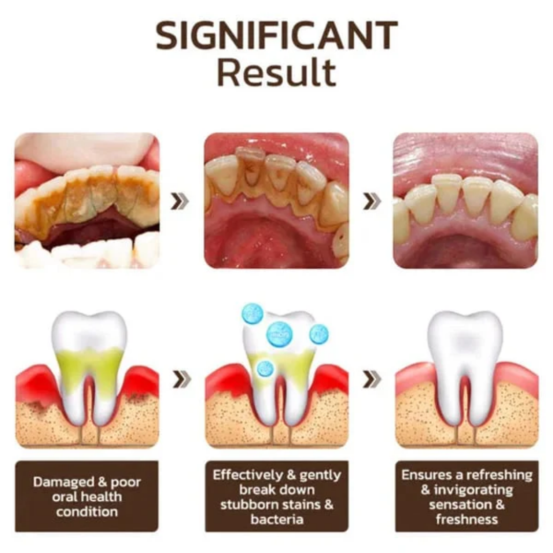 Dentifrice blanchissant probiotique Gestion de la santé bucco-dentaire(Élimine des années de taches)