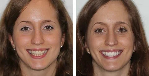 Second Dentifrice blanchissant probiotique Gestion de la santé bucco-dentaire(Élimine des années de taches)