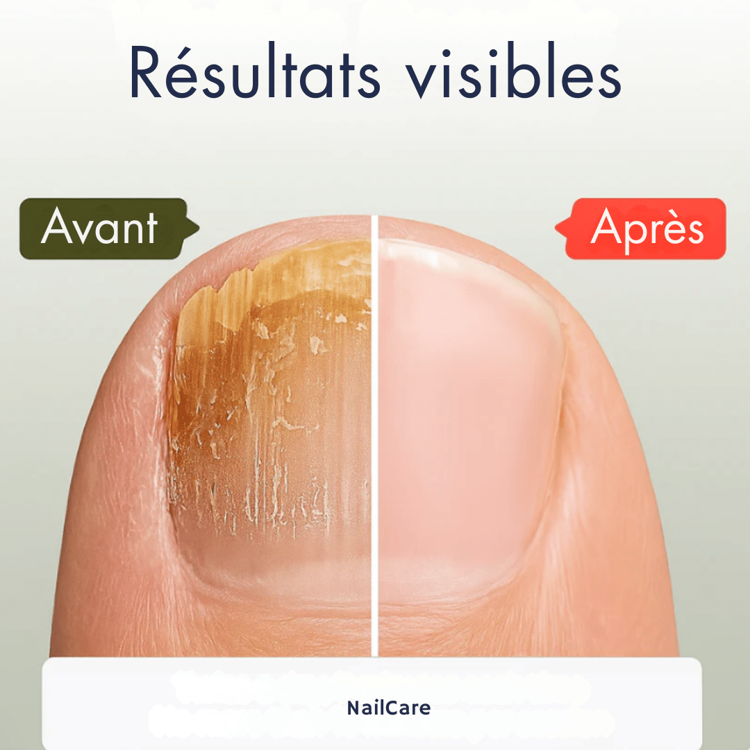 Traitement anti-mycoses des ongles (7 jours).