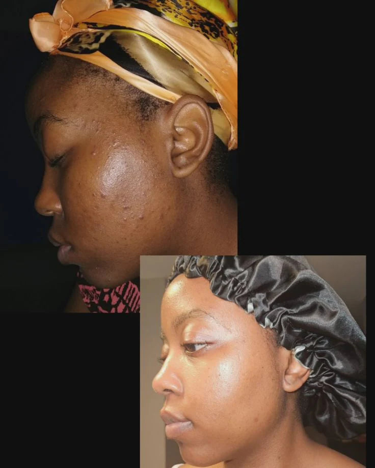 Savon Kojic San : Éclat Naturel, Peau Nette, Fraîche & Éclatante
