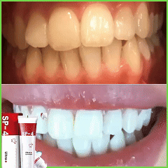 Dentifrice blanchissant probiotique Gestion de la santé bucco-dentaire(Élimine des années de taches)