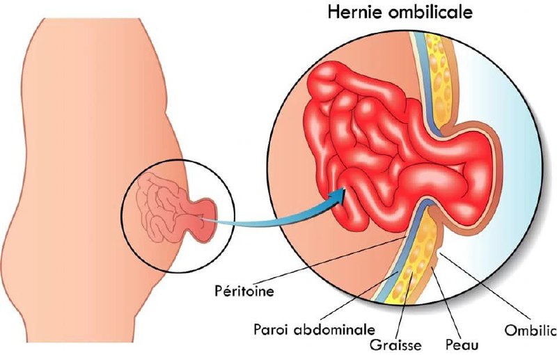 Crème Anti-Hernie Sumifun