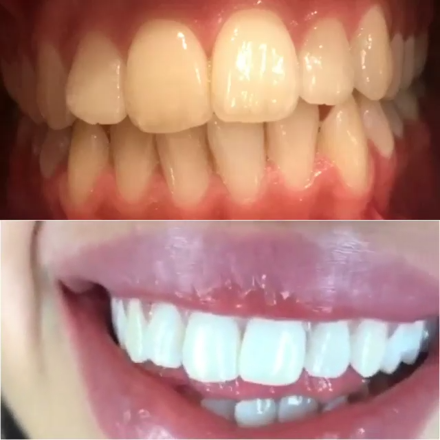 Dentifrice blanchissant probiotique Gestion de la santé bucco-dentaire(Élimine des années de taches)